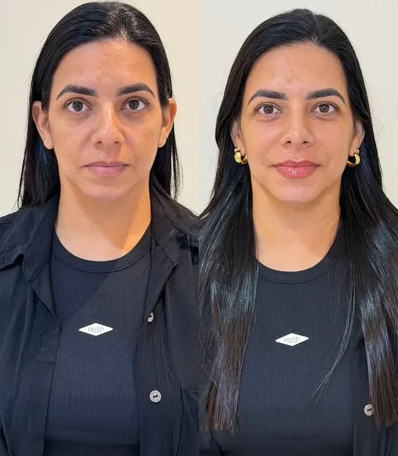 Antes e depois — Harmonização full face