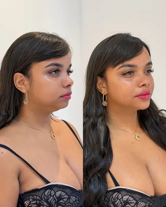 Antes e depois — Harmonização facial