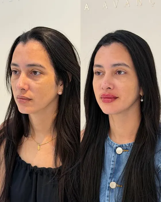 Antes e depois — Harmonização facial