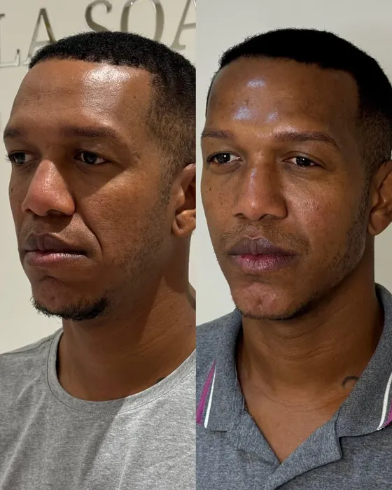 Antes e depois — Harmonização masculina