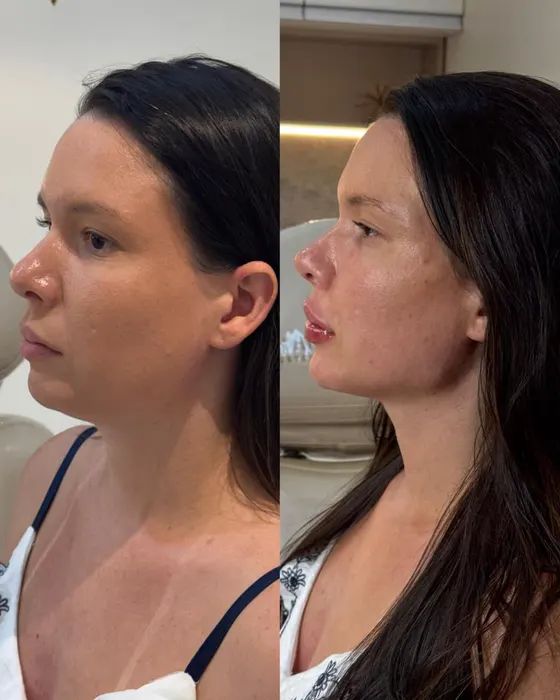 Antes e depois — Perfil & rinomodelação
