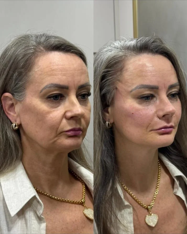 Antes e depois — rejuvenescimento facial