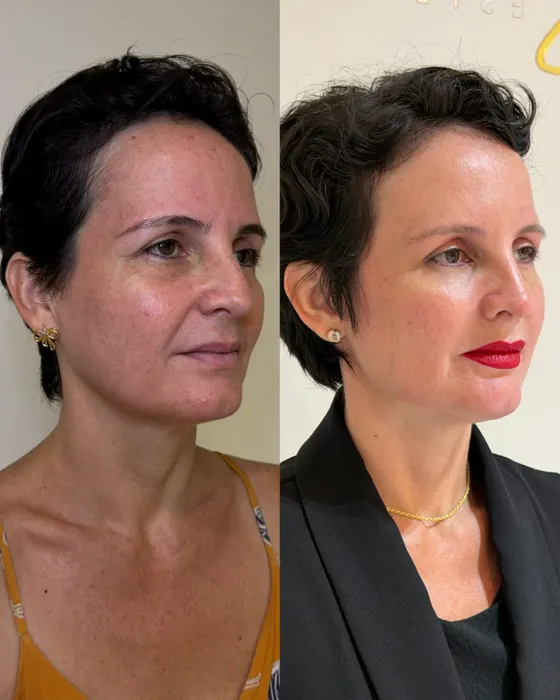 Antes e depois — Rejuvenescimento facial