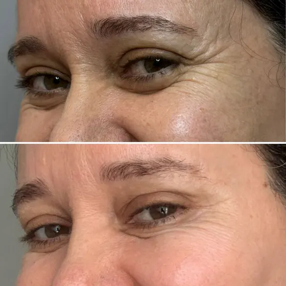 Antes e depois — Olheiras